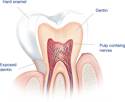 ما الذي يسبب الأسنان الحساسة
