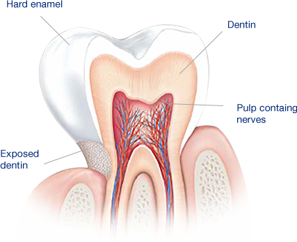 What Causes Sensitive Teeth? What Causes Sensitive Teeth?